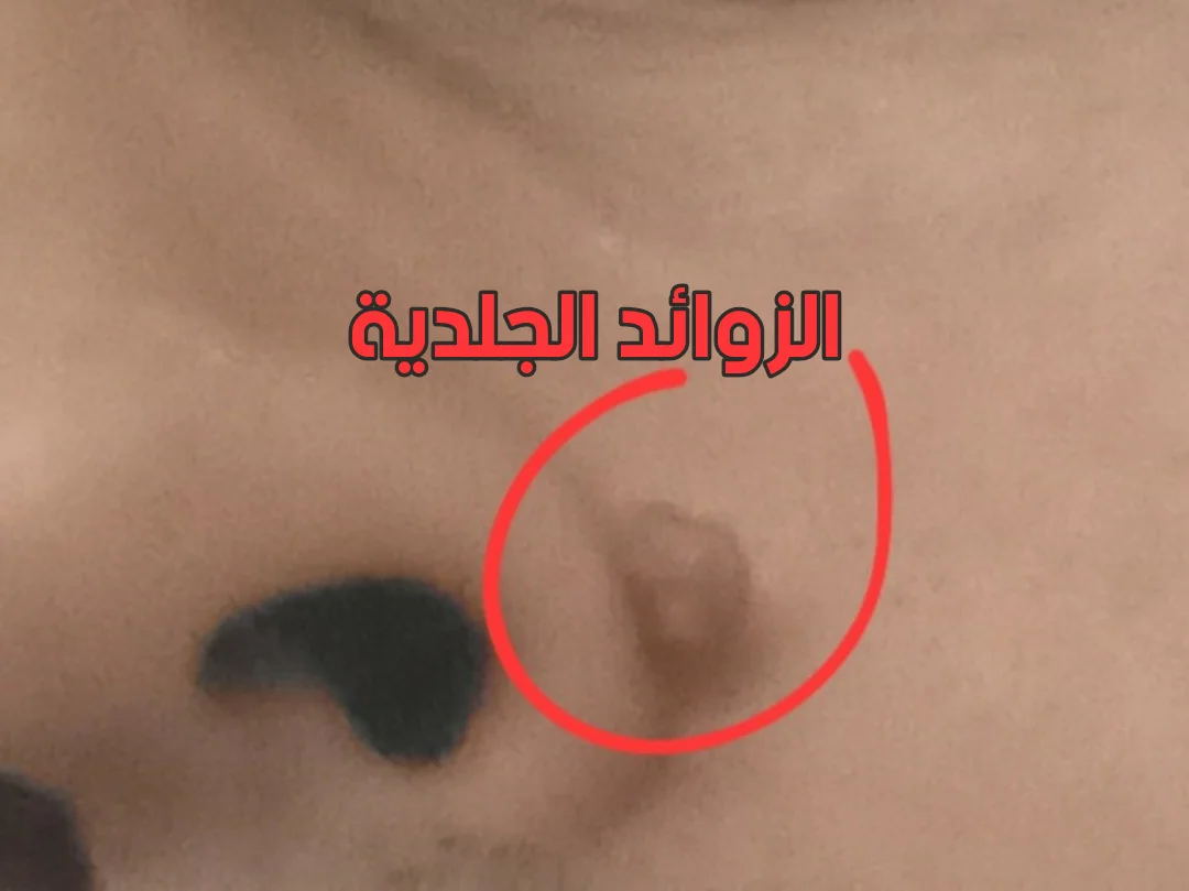 الزوائد الجلدية أشكالها وعلاجها
